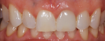 At the 2-week postoperative visit, the patient liked the rounded distoincisal edge of tooth No. 9 and asked for it to be replicated on tooth No. 8.