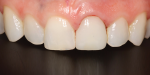 A slight modification was made to the distoincisal edge of tooth No. 8, which helped it look a little softer and more feminine.