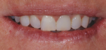 At the 2-week postoperative visit, the patient liked the rounded distoincisal edge of tooth No. 9 and asked for it to be replicated on tooth No. 8.