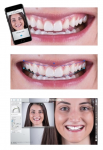 The 3Shape Smile Design app, built on Digital Smile Design principles, helps create highly esthetic restorative treatment plans based on a patient’s desired smile. The suggested restoration can be drawn directly on a patient’s 2D image using the app—a workflow that takes only minutes.