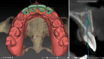 This single software solution from Nobel Biocare and KaVo Kerr allows clinicians, radiologists, operators, assistants, hygienists, and dental technicians to collaborate in a modular solution.