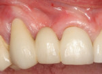 Fig 1. Initial clinical situation of teeth Nos. 6 and 8.