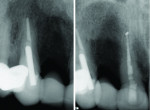 Fig 2. Initial situation radiographically of teeth Nos. 6 and 8.