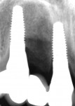 Fig 10. Six-year postoperative radiographically.