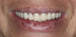 Fig 13. Provisional prosthesis inserted. The prosthesis was esthetic, fixed, and functional allowing the patient to smile and speak without fear.