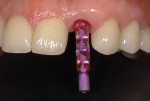 Fig 5. Single restorations were placed from Nos. 4 through 12. For the implant in position No. 10, an open-tray impression technique was used to pickup the implant position. The open tray was chosen to maintain the most accurate relationship of the implant to the adjacent teeth.