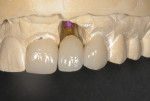 Fig 11. A patient-specific all-zirconia Atlantis abutment (Dentsply Sirona) was designed and manufactured with the approval of the laboratory and the clinician, as was an all-ceramic full-crown final restoration.