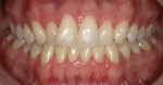 Fig 7. Preoperative photographs may also include buccal and frontal retracted views together, as shown here, to help patients visualize their dentition. These photos further enabled the patient to see the white spots and misalignment of the teeth from different angles.
