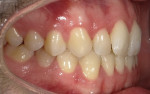 Fig 6. Preoperative photographs may also include buccal and frontal retracted views together, as shown here, to help patients visualize their dentition. These photos further enabled the patient to see the white spots and misalignment of the teeth from different angles.