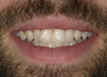 Fig 4. Close-up photographs of the patient’s preoperative smile utilizing Standard mode (Fig 4) and Isolate Shade mode (Fig 5), which is helpful for shade matching, clearly revealed the white-spot lesions. These photographs helped the patient/clinician communication as the patient agreed not only to the whitening treatment, but also to the clear aligner therapy.