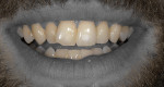 Fig 5. Close-up photographs of the patient’s preoperative smile utilizing Standard mode (Fig 4) and Isolate Shade mode (Fig 5), which is helpful for shade matching, clearly revealed the white-spot lesions. These photographs helped the patient/clinician communication as the patient agreed not only to the whitening treatment, but also to the clear aligner therapy.