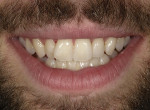 Fig 11. The patient was pleased with his improved teeth shade. Additionally, the patient now understands the esthetic problems associated with malocclusion and
will begin clear aligner therapy to complete the case.