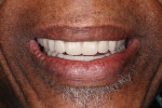 Fig 2. Smile with new maxillary and mandibular complete dentures.
