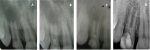 Fig 1. Periapical radiographic analysis: Initial condition of the patient, denoting incomplete root formation and diffuse radiolucent region. 
Fig 2. Three weeks after root canal irrigation treatment, denoting decrease in radiolucent region and neo-formation of hard tissues along the apex of tooth No. 7. 
Fig 3. Three months postoperative, denoting stronger bone formation on periapical regions and maintenance of canal dimensions (thickness and height). 
Fig 4. Follow-up radiography at 72 months, denoting obliteration of tooth apex and maturation of bone tissues in the periapical regions.