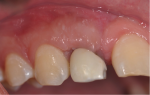 Fig 8. Clinical aspect 3 months after periodontal surgery, which was performed to resolve the gingival discoloration issue (patient’s major concern at 72 months).