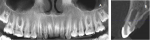 Fig 5. CBCT panoramic view after 72 months, denoting bone densities that are comparable to non-affected regions. 
Fig 6. Axial slice of treated teeth after 72 months, denoting clear obliteration of the canal.