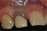 Fig 7. Clinical aspect 72 months after treatment, denoting strong discoloration of cervical gingival tissue.