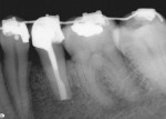 Radiograph after 4.5 years.