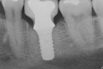 Initial pretreatment radiograph of an implant.