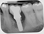 Radiograph of the same implant taken 3
years later, demonstrating how rapidly peri-implantitis bone loss occurs.