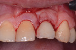 View immediately following laser-assisted peri-implant mucositis treatment with an Nd-YAG laser.