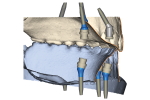 Fig 4. Note the denture-to-friction-fit-cap relationship and nonparallel implants in the maxilla compared to the parallel placement in the mandible.