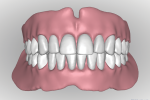 Fig 19. The completed digital design of teeth and gingival base is viewed from the facial perspective.