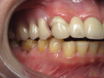 Fig 1. Completely transparent traditional denture material may not provide desirable esthetics.