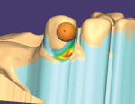 Fig 3. In undercut mapping, exocad shows the lightest undercut in blue, then moves to green, yellow, orange, and finally red, the most extreme.