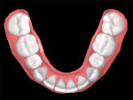Engagers were removed from teeth Nos. 26, 25, 24, 23, and 20, and the patient was placed into retention.