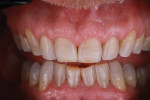 Patient teeth after preparation is completed using FirstFit preparation guides.