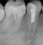 Final periapical radiograph taken after regenerative endodontic treatment on tooth No. 29.