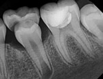 Final radiograph taken after vital pulp cryotherapy treatment on tooth No. 19.