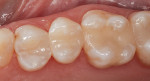 Teeth restored with a composite resin that utilizes structural color technology. The shade
of these teeth is Vita B1.