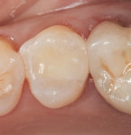 Teeth restored using the same single-shade
composite resin as in Figure 1. The shade of these teeth is Vita A3.