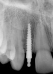 Fig 6. Preoperative photograph showing congenitally missing teeth Nos. 7 and 10 (Fig 4); post placement of MDIs at Nos. 7 and
10 (Fig 5); periapical radiograph, post MDI placement, No. 7 (Fig 6); periapical radiograph, post MDI placement, No. 10 (Fig 7); post cementation of two lithium-disilicate MISFRs, Nos. 7 and 10 (Fig 8).