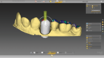 Fig 7. Once parameters are set, the position of the tooth in the arch can be adjusted for optimal results.