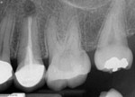 Immediately visible radiographic differences between traditional and modern surgical approaches.