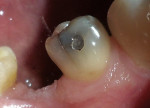 Figure 2  Tooth No. 20 displayed numerous cracks into the dentin, indicating that the tooth was structurally compromised.