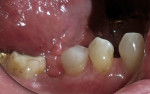 Figure 10  A brief polish with coarse pumice on a prophy cup imparted a smooth finish to the tooth/restoration.