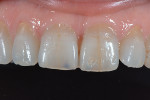 Fig 3. Retracted 1:1 view showed the translucent incisal third and Class 5 composite restorations.