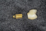 Two-piece, screw-retained implant crown and abutment. The crown is cemented to the abutment outside of the mouth.