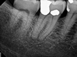 Preoperative radiograph of tooth No. 31, which was diagnosed with SIP and symptomatic apical periodontitis, in a patient with severe preoperative pain. After an IANB (3.4 mL of 2% lidocaine with epinephrine 1:100,000) and buccal infiltration (1.7 mL of 4% articaine with
epinephrine 1:100,000) were performed, a false negative thermal test was noted upon instrumentation of the pulp chamber; therefore, an intrapulpal injection (0.9 mL of 3% mepivacaine) was administered.