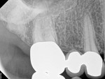 Preoperative radiograph of tooth No. 3 with a diagnosis of SIP and symptomatic apical periodontitis. After an initial infiltration (3.4 mL of 2% lidocaine with epinephrine 1:100,000), an additional infiltration (1.7 mL of 0.5% bupivacaine with epinephrine 1:200,000), and a PDL injection (0.6 mL of 3% mepivacaine), the thermal test demonstrated insufficient pulpal anesthesia; therefore, nitrous oxide was administered, which yielded a negative pulpal response.
