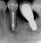 Immediate postoperative radiograph of the root canal system filled with bioceramic root canal sealer and gutta-percha.