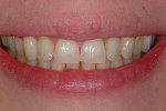 Pretreatment smile photograph. Note the flaring and rotation of the maxillary lateral incisors and the chipped incisal edges of the
maxillary central incisors.