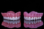 Fig 1. Printed (left) and milled (right) dentures display similar levels of esthetics.