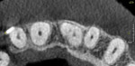 Fig 3. Axial section of the CBCT scan confirmed the presence of two root canals in tooth No. 9.