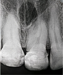 Fig 1 and Fig 2. Preoperative radiography showed unusual tooth No. 9 anatomy.