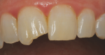 Pretreatment close-up view of previously treated fractured maxillary right central incisor that experienced debonding of its composite restoration.